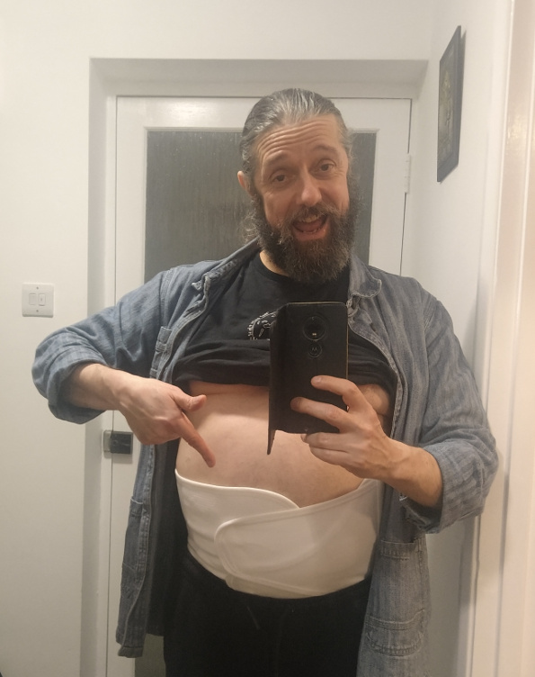 Selfie of a middle-aged man with a beard holding with his T-shirt pulled up to reveal the white abdominal truss around his middle